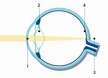 W przypadku prezbiopii promienie światła są załamywane przez rogówkę (1) i soczewkę oka (2), ale ognisko (3) światła dostającego się do oka znajduje się za siatkówką (4).