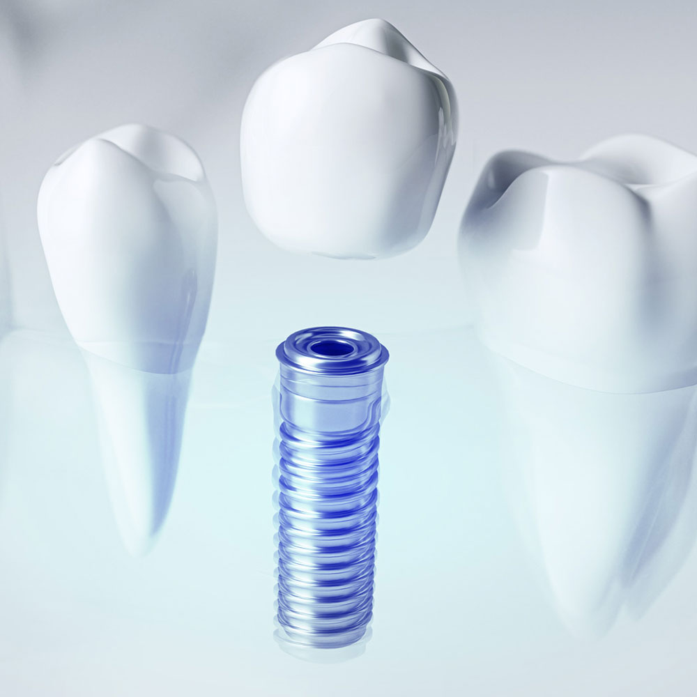 Implanty dentystyczne