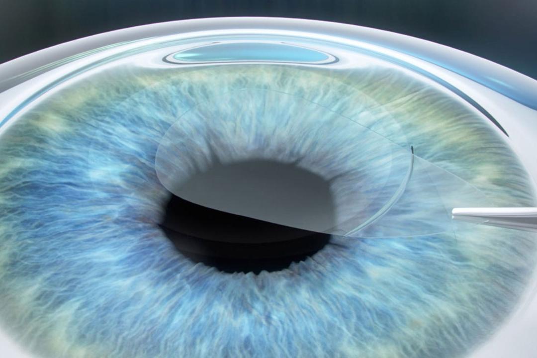 Nowa metoda ReLEx™ smile marki Carl Zeiss Meditec rewolucjonizuje zabiegi laserowe
